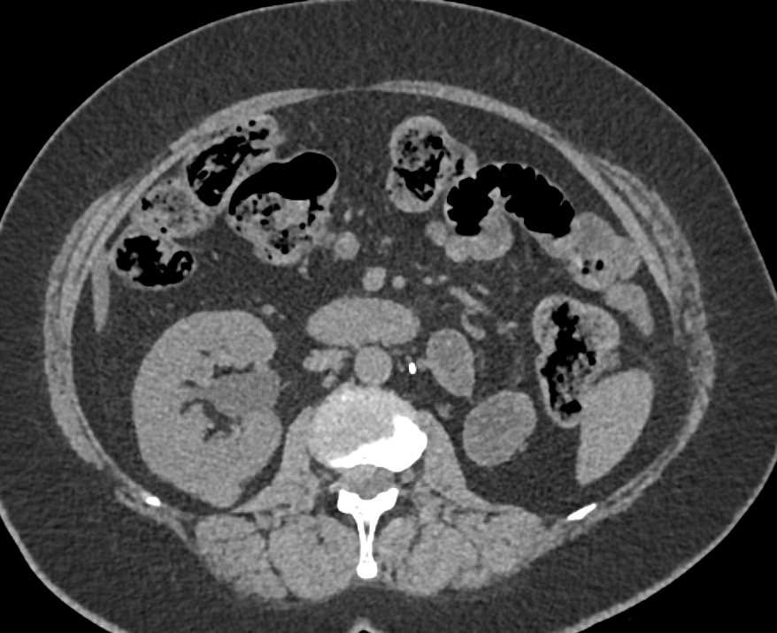 Post Left Nephrectomy to Metastases to the Contralateral Right Kidney - CTisus CT Scan