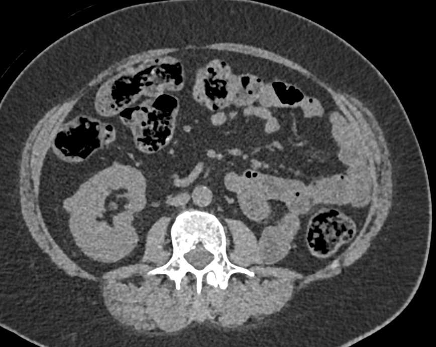 Post Left Nephrectomy to Metastases to the Contralateral Right Kidney - CTisus CT Scan