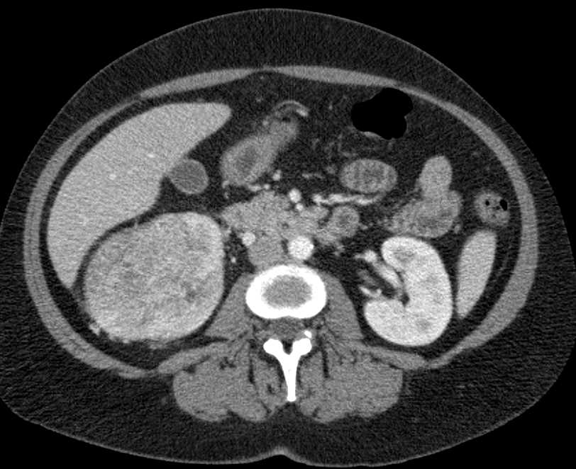 Papillary Renal Cell Carcinoma Right Kidney - CTisus CT Scan