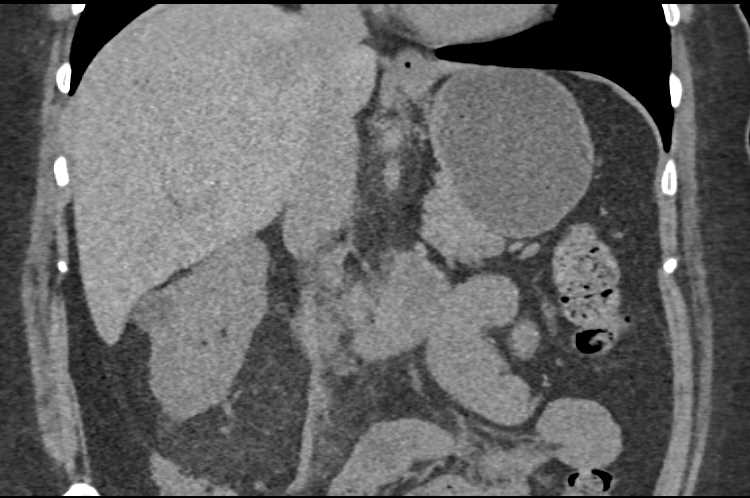 Angiomyolipoma Right Kidney Simulates a Liposarcoma Near the Right Kidney - CTisus CT Scan