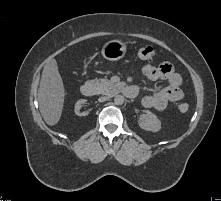 Papillary Renal Cell Carcinoma in the Native Left Kidney in a Renal Transplant Patient - CTisus CT Scan