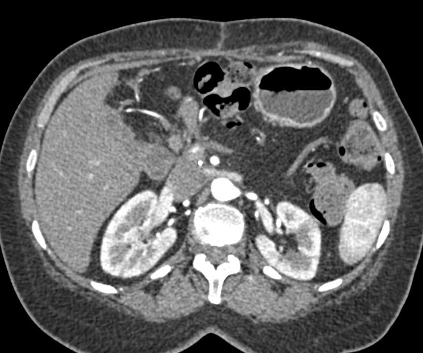 Patchy Enhancement Left Kidney due to Pyelonephritis - CTisus CT Scan