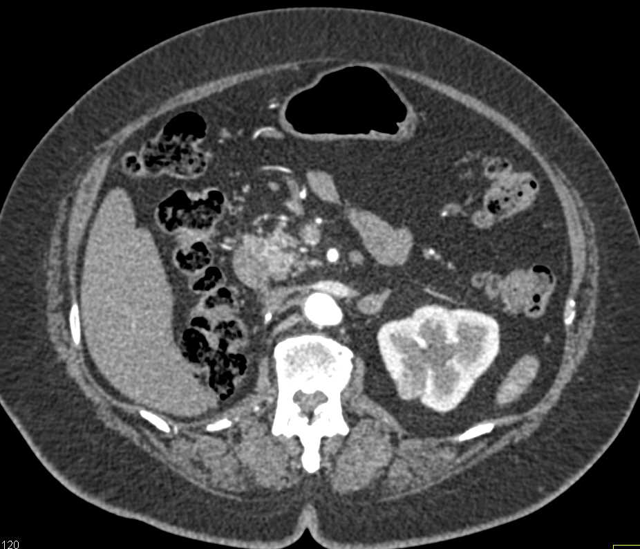 Recurrent Renal Cell Carcinoma Metastatic to the Pancreas, Contralateral Adrenal and Adenopathy - CTisus CT Scan