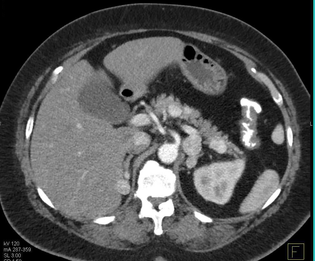 Recurrent Renal Cell Carcinoma Metastatic to the Pancreas, Contralateral Kidney and Adrenal and Adenopathy - CTisus CT Scan