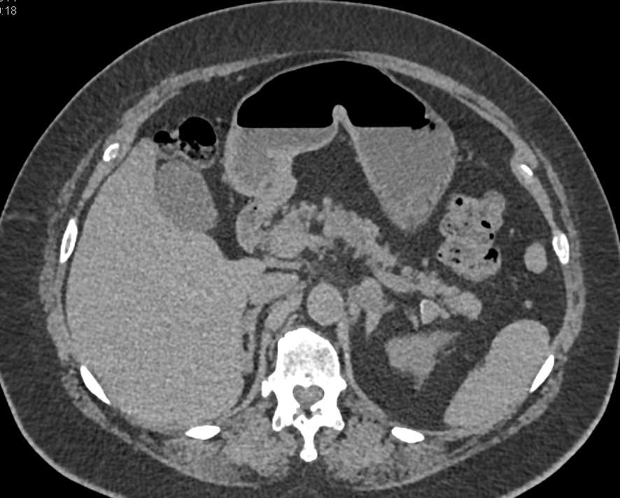 Recurrent Renal Cell Carcinoma Metastatic to the Pancreas, Contralateral Kidney and Adrenal and Adenopathy - CTisus CT Scan