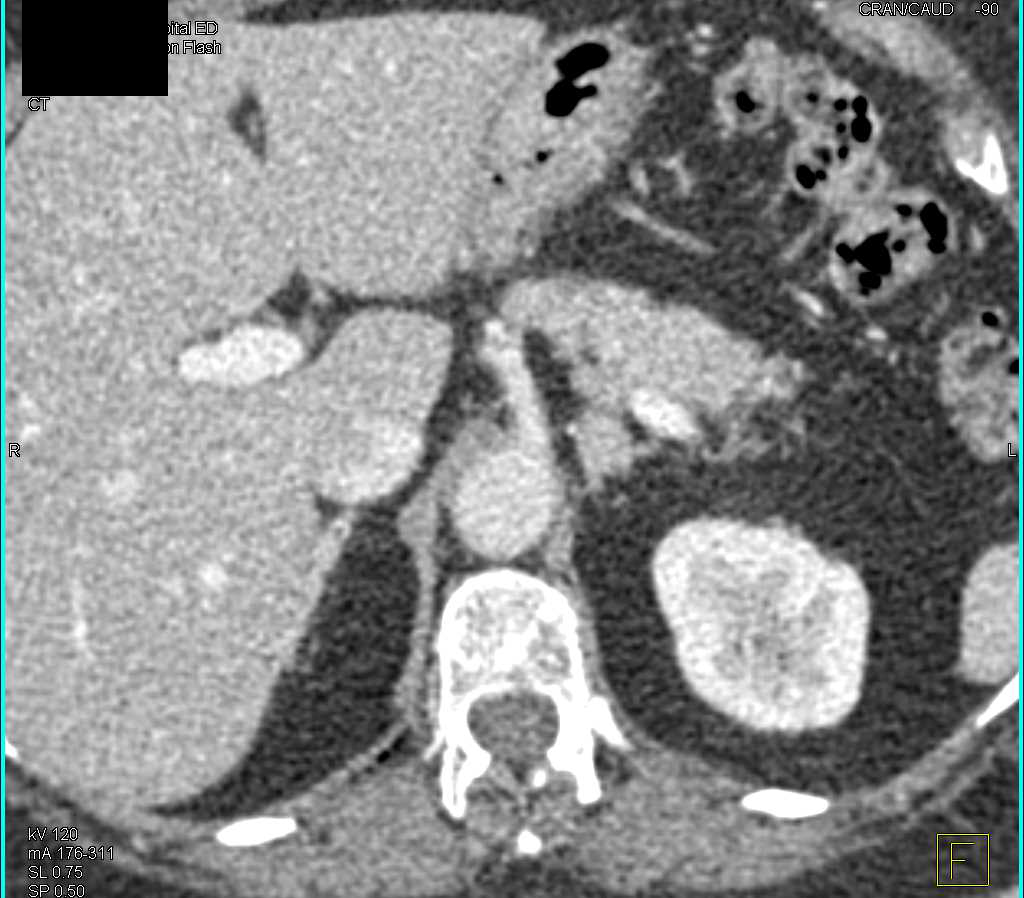 Stone Seen on Contrast Study - CTisus CT Scan