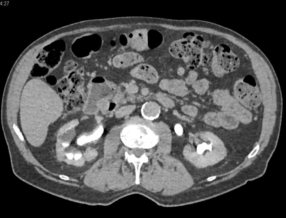 Carcinoma at the Right Ureterovesical Junction (UVJ) - CTisus CT Scan