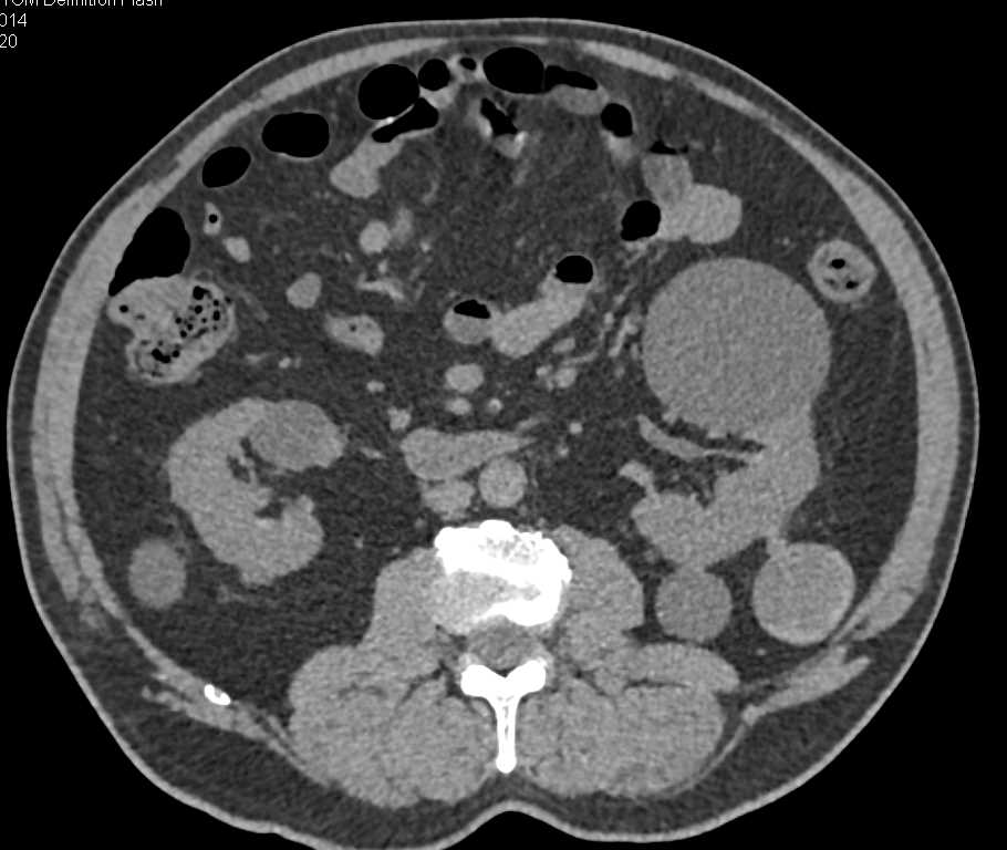 High Density Renal Cysts Left Kidney - CTisus CT Scan