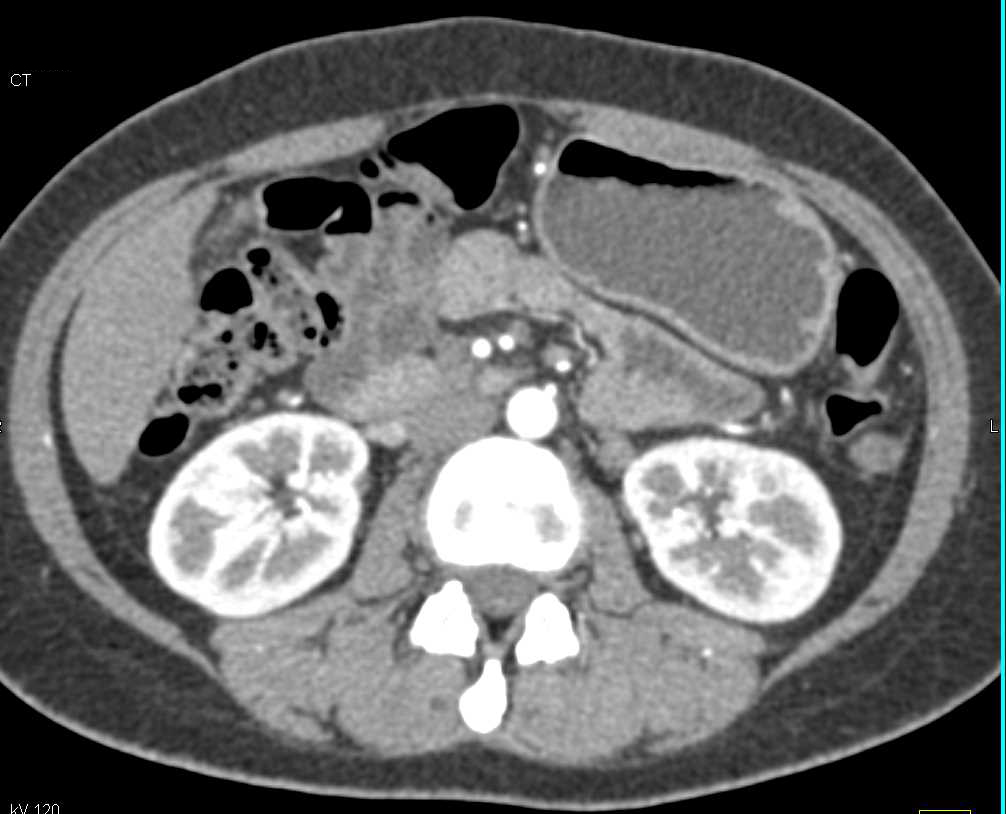 Angiomyelolipoma (AML) Left Kidney and Lipomas in the Liver - CTisus CT Scan