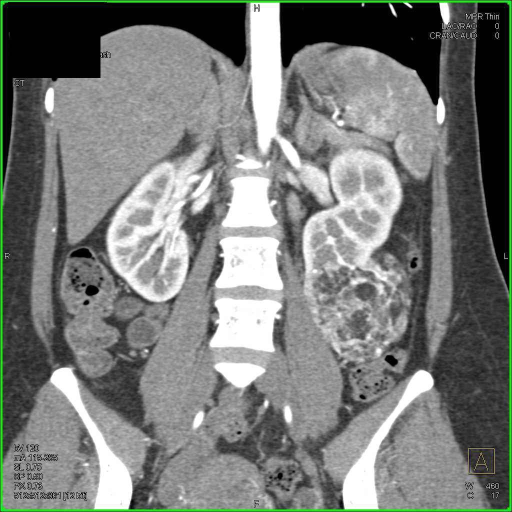 Angiomyelolipoma (AML) Left Kidney and Lipomas in the Liver - CTisus CT Scan