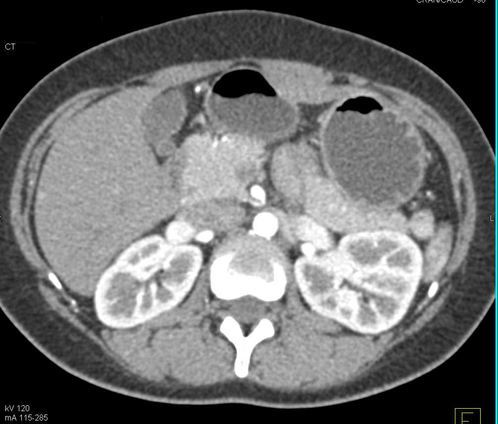 Angiomyelolipoma (AML) Left Kidney and Lipomas in the Liver - CTisus CT Scan