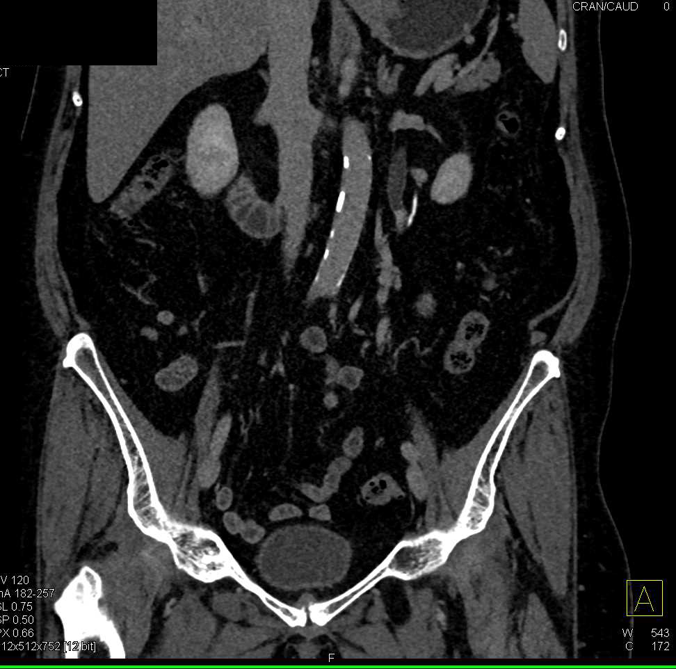 Ureteropelvic Junction (UPJ) with Dilated Right Renal Pelvis - CTisus CT Scan