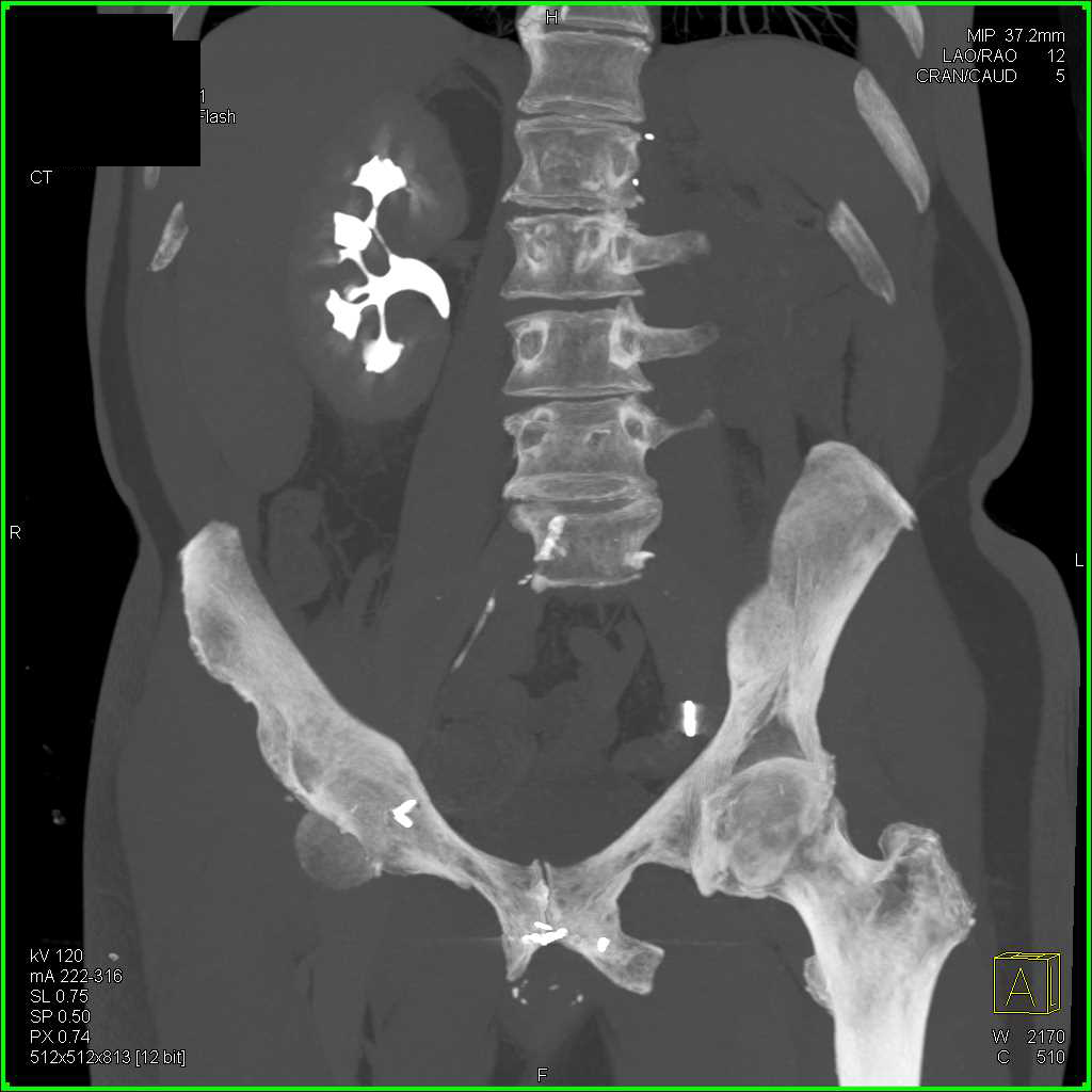 Clear Cell Carcinoma Left Kidney - CTisus CT Scan