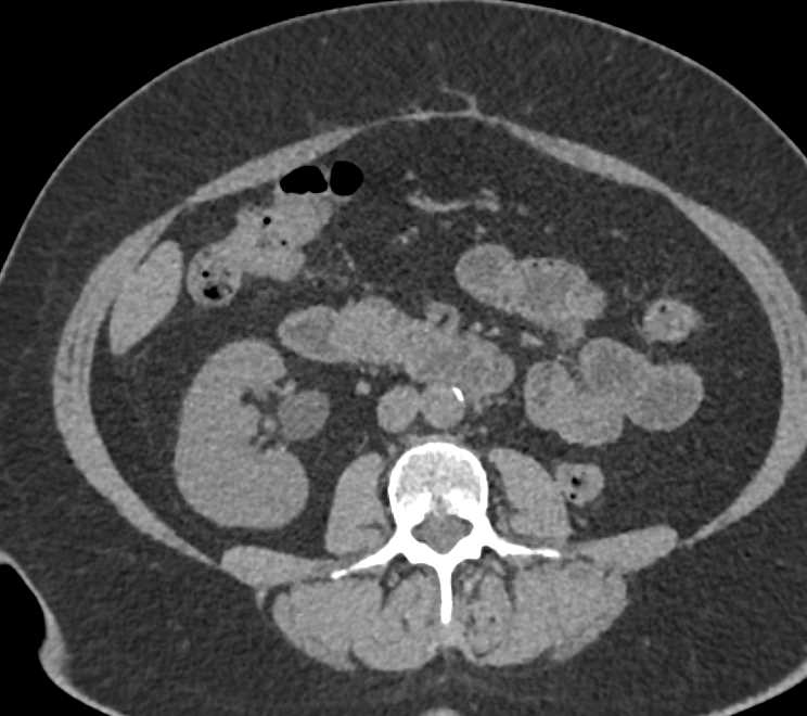 Transitional Cell Cancer (TCC) in Right Ureter Best Seen on 3D Images - CTisus CT Scan