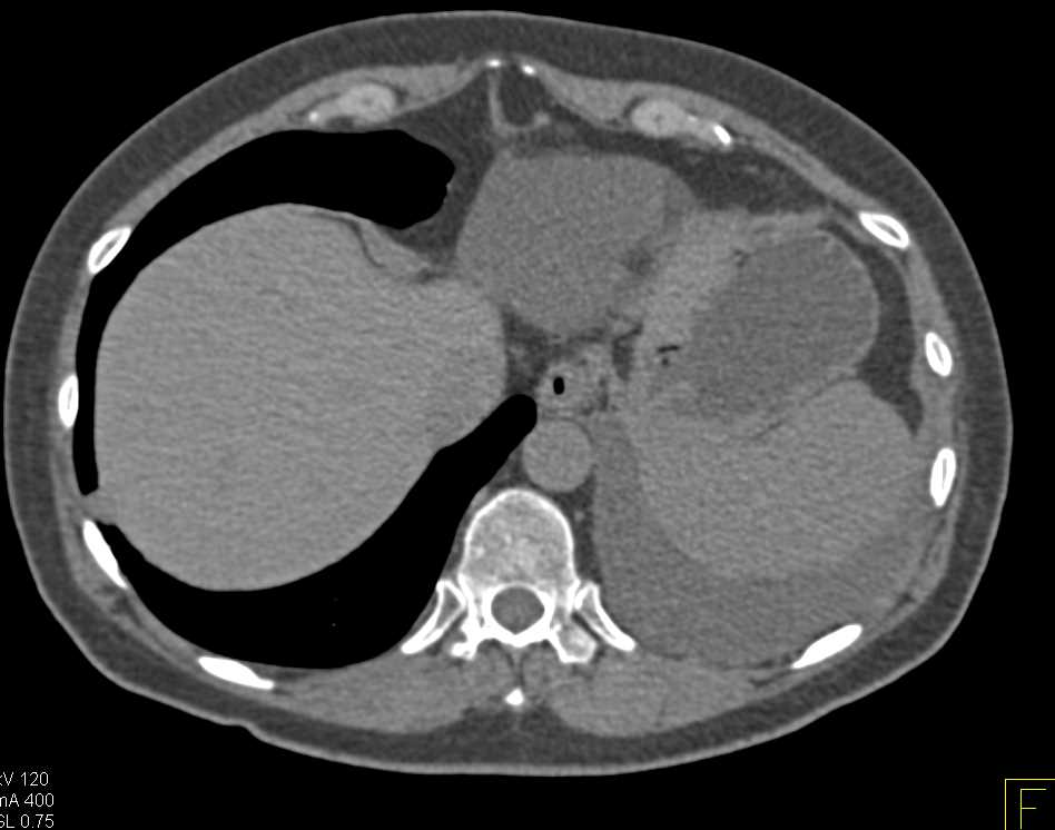 Renal Cell Carcinoma with Dystrophic Calcification - CTisus CT Scan