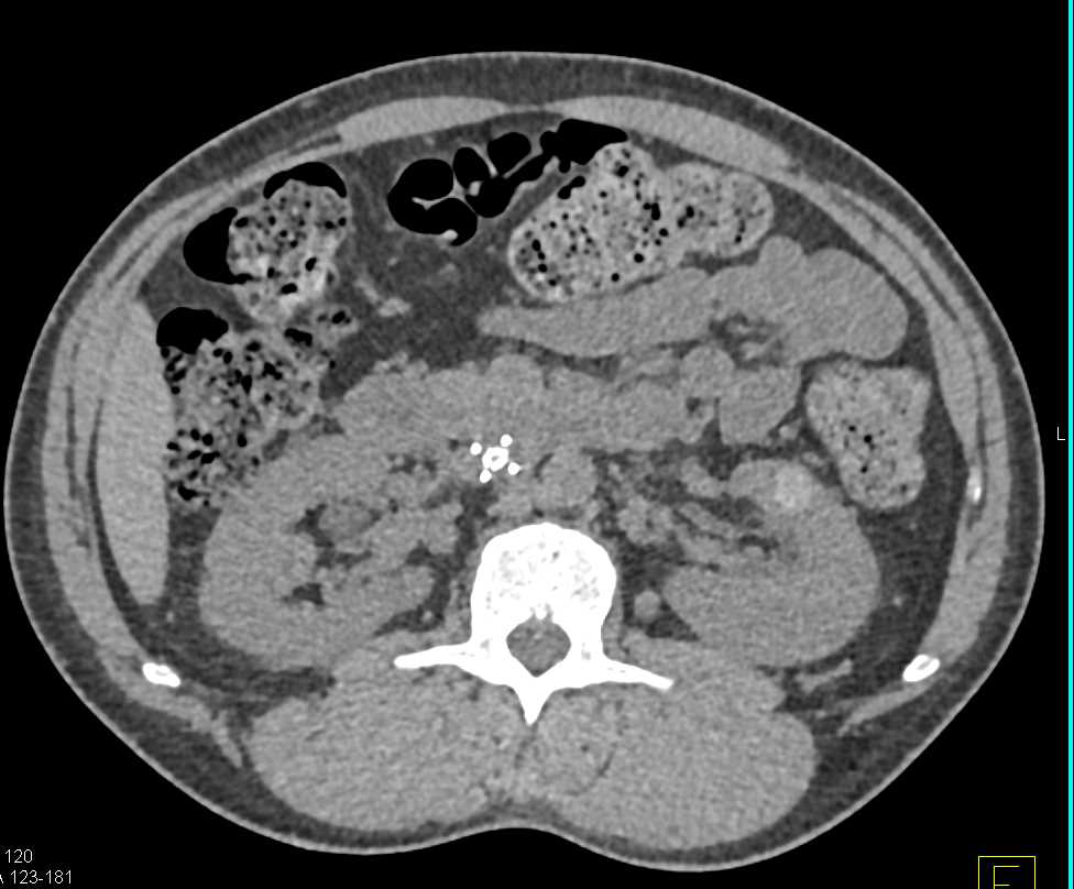 High Density Renal Cyst Left Kidney in Multiple Phases - CTisus CT Scan