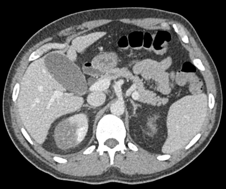 Multiple Renal Infarcts Right Kidney - CTisus CT Scan