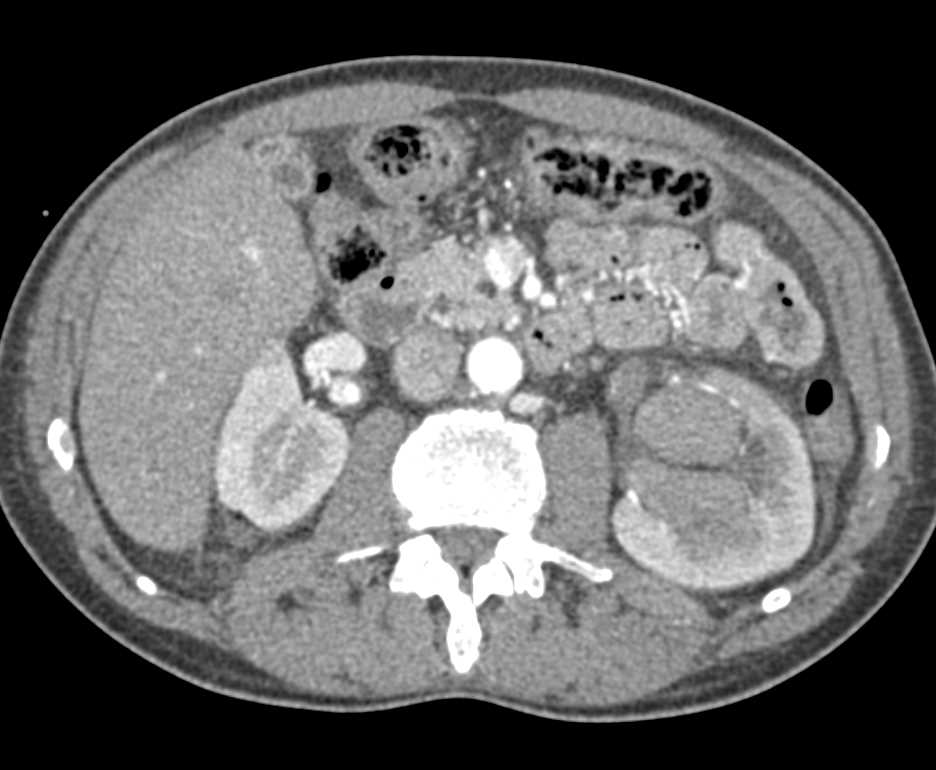 Transitional Cell Carcinoma Left Renal Pelvis Invading the Kidney - CTisus CT Scan