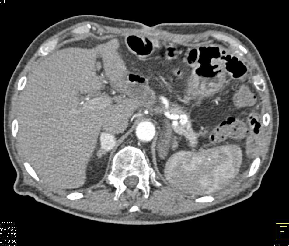 Left Nephrectomy with Contralateral Adrenal Metastases - CTisus CT Scan