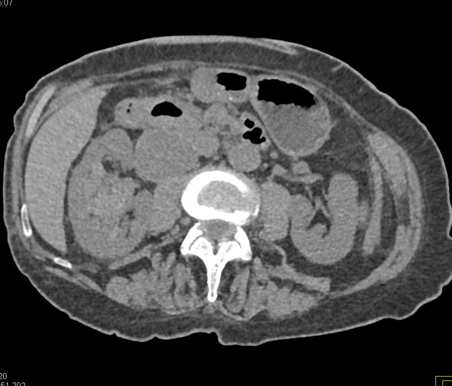 Infiltrating Renal Cell Carcinoma Involves the Renal Vein and Inferior Vena Cava (IVC) - CTisus CT Scan