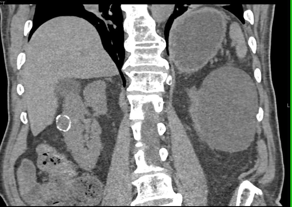 Incidental Right Bosniak 2B Cyst - CTisus CT Scan