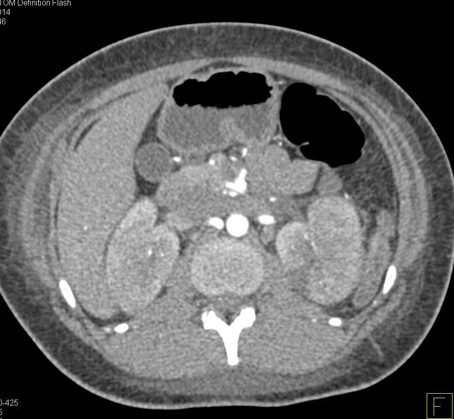 Acute Pyelonephritis Best Seen on Excretory Phase Images - CTisus CT Scan