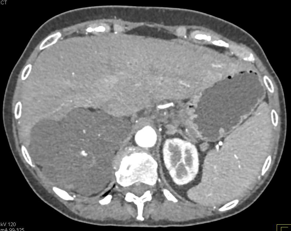 MEST or Mixed Epithelial Stromal Tumor - CTisus CT Scan