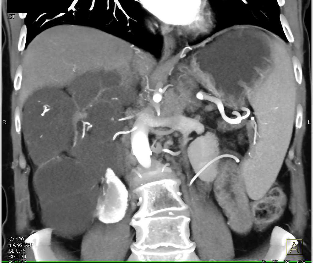 MEST or Mixed Epithelial Stromal Tumor - CTisus CT Scan