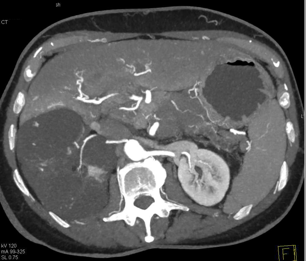 MEST Tumor Kidney - CTisus CT Scan