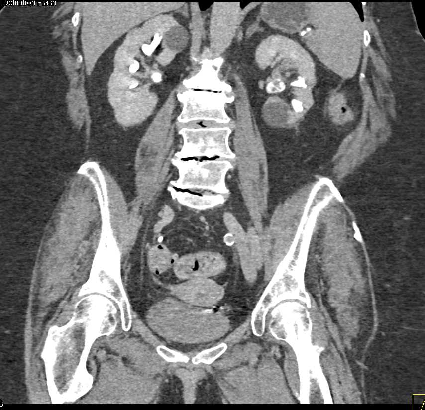 Transitional Cell Carcinoma Left Renal Pelvis - CTisus CT Scan