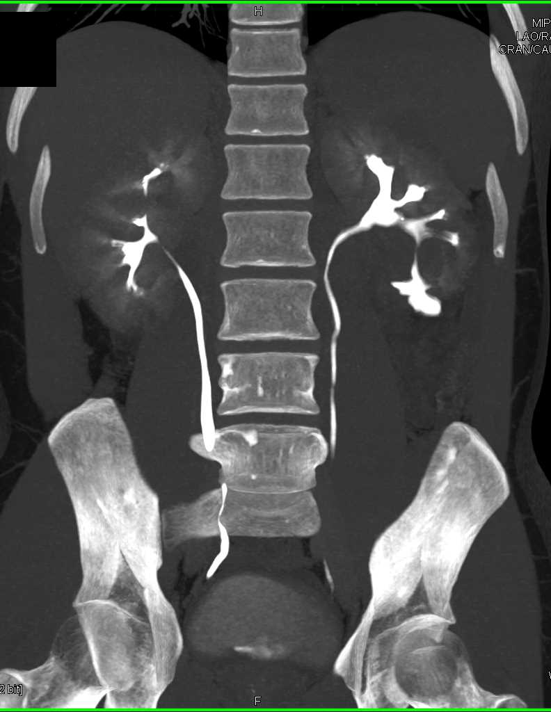 Tuberous Sclerosis with Multiple Bilateral Renal Angiomyolipomas - CTisus CT Scan