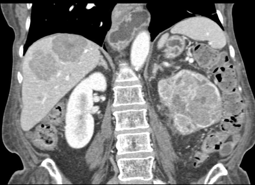 Renal Cell Carcinoma with Liver Metastases - CTisus CT Scan