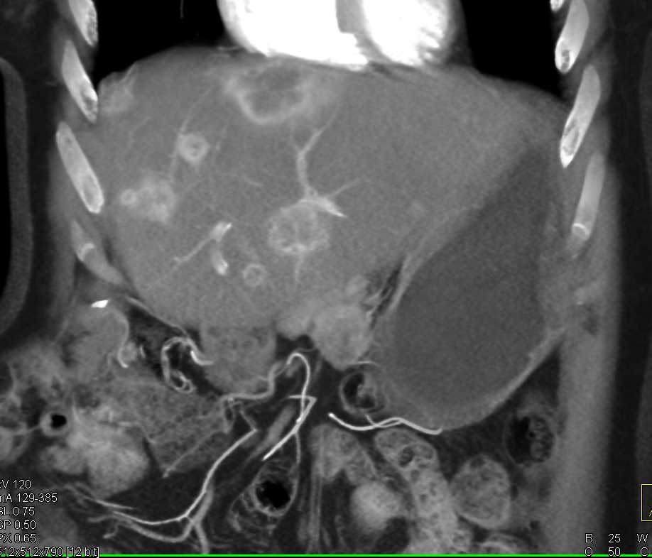 Metastatic Renal Cell Carcinoma to the Omentum and Liver - CTisus CT Scan