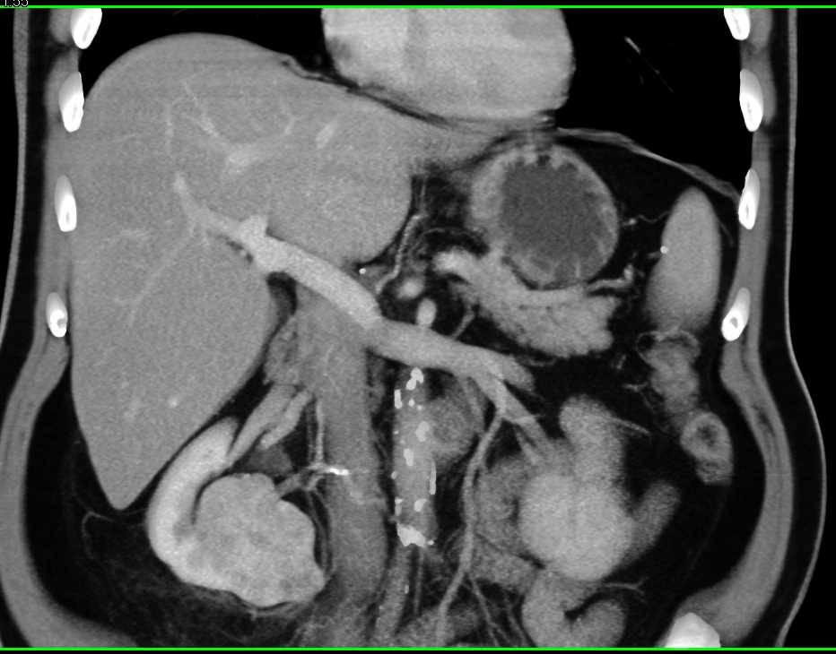 Papillary Renal Cell Carcinoma Right Kidney - CTisus CT Scan