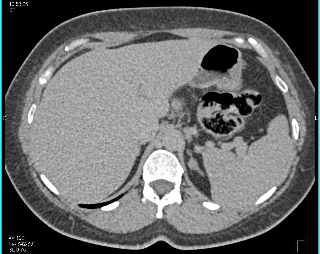 Bilateral Renal Angiomyolipomas - CTisus CT Scan