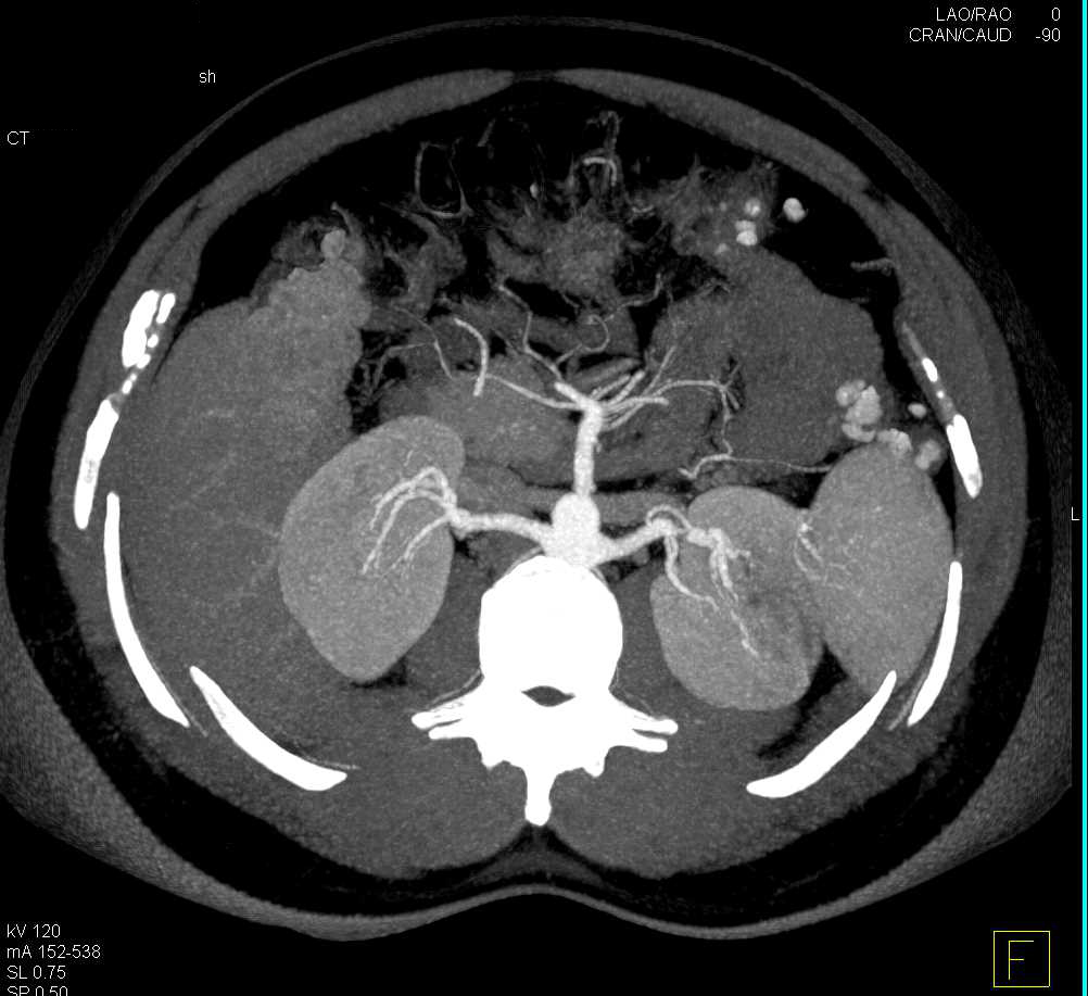 Clots in Left Renal Artery with Renal Infarction - CTisus CT Scan