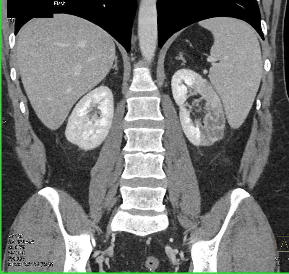 Clots in Left Renal Artery with Renal Infarction - CTisus CT Scan