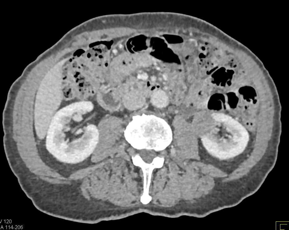 Papillary Renal Cell Carcinoma Left Kidney - CTisus CT Scan