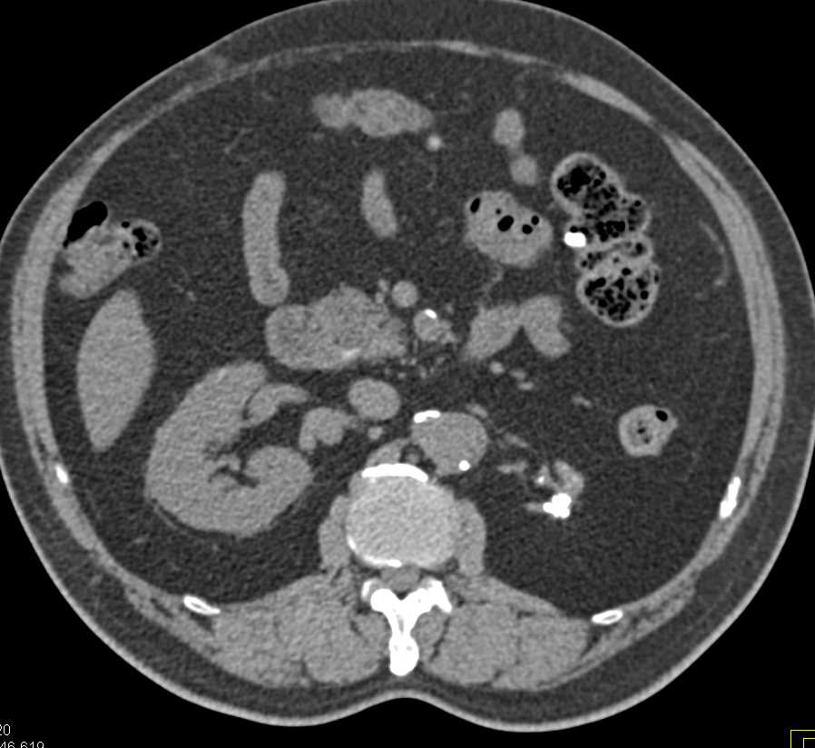 Atrophic Left Kidney - CTisus CT Scan