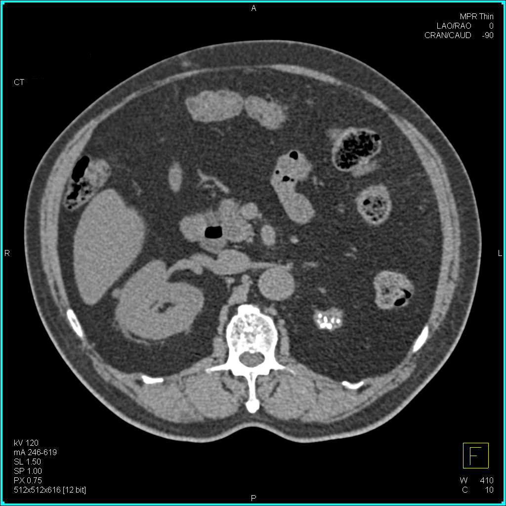 Atrophic Left Kidney Kidney Case Studies Ctisus Ct Scanning