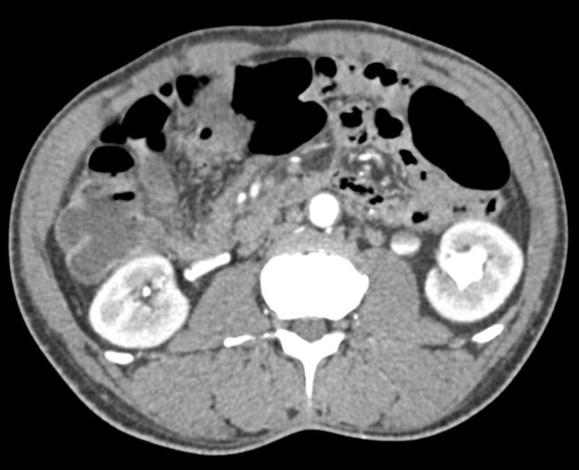 Obstructed Left Ureter with a Ureteral Calculi - CTisus CT Scan