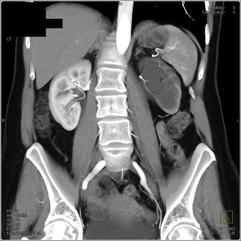 Left Hydronephrosis due to Transitional Cell Cancer (TCC) in the Mid Left Ureter - CTisus CT Scan