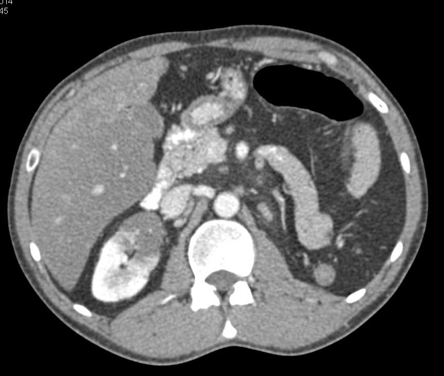 Infarction Lower Pole Left Kidney - CTisus CT Scan