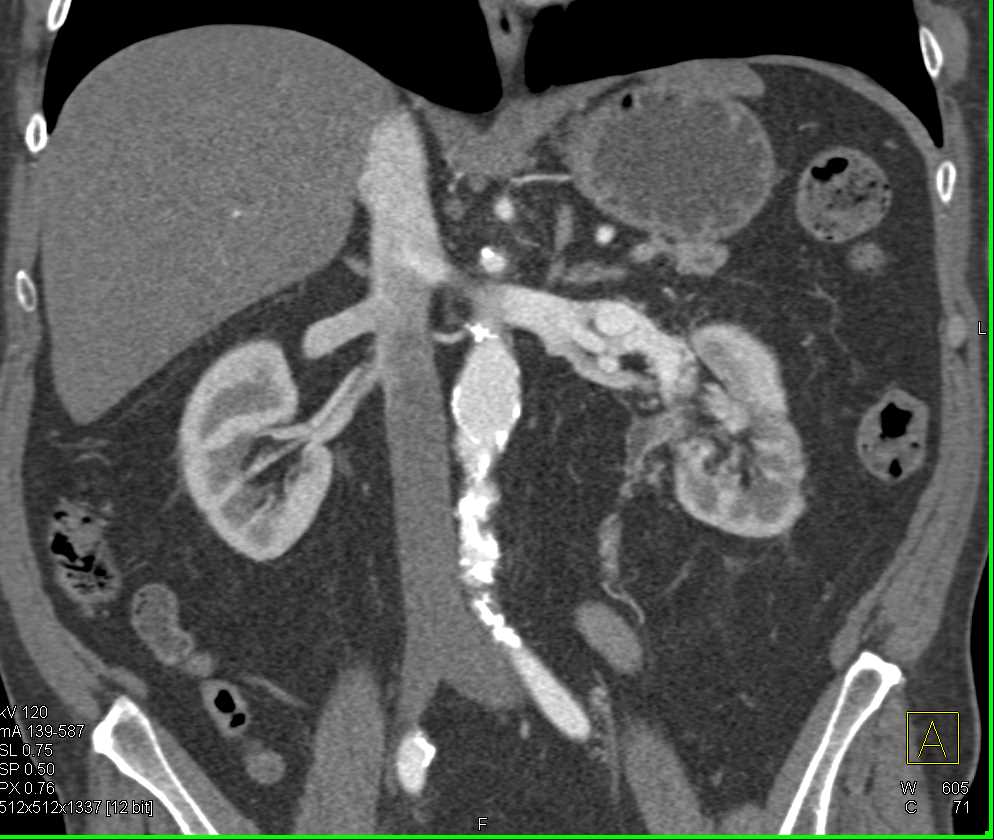 Arteriovenous (AV) Fistulae Left Renal Pelvis due to Tumor - CTisus CT Scan