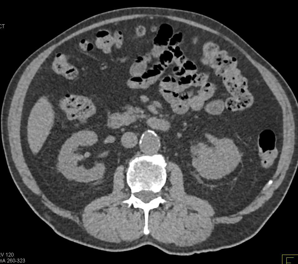 Arteriovenous (AV) Fistulae Left Renal Pelvis due to Tumor - CTisus CT Scan