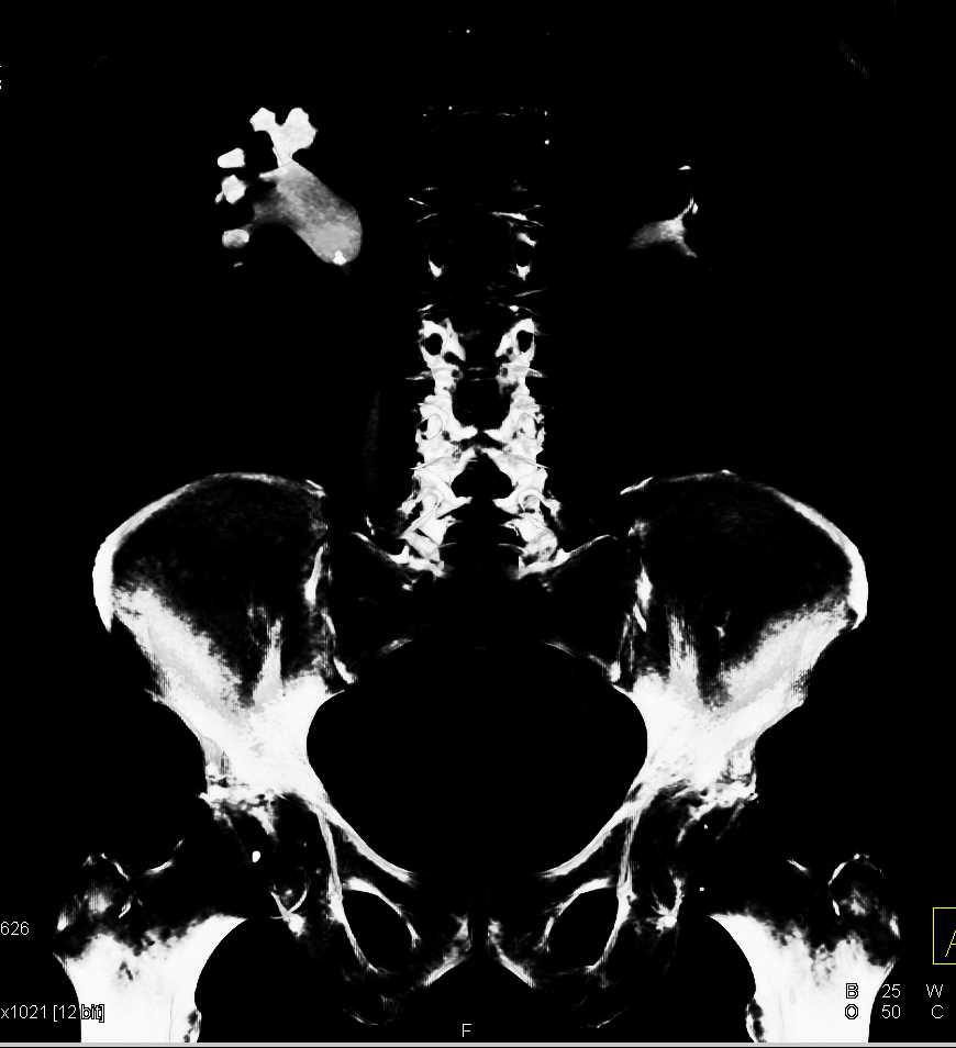 Stone Impacted at Right Ureteropelvic Junction (UPJ) Seen on 3D Maps - CTisus CT Scan