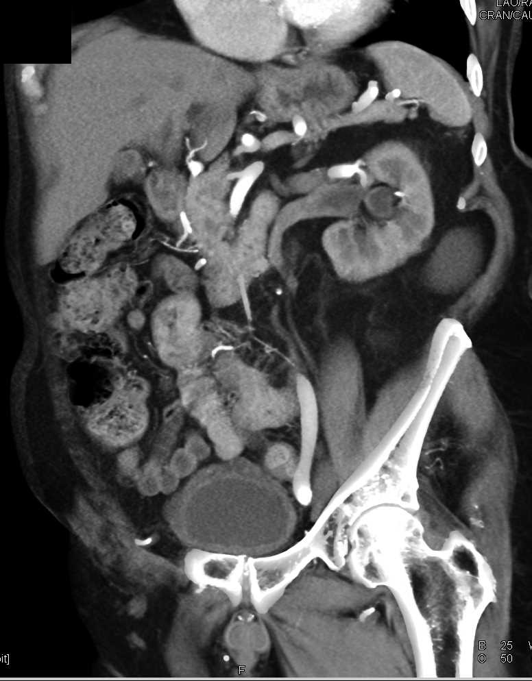 Transitional Cell Carcinoma Left Renal Pelvis and Left Ureter in 3D - CTisus CT Scan