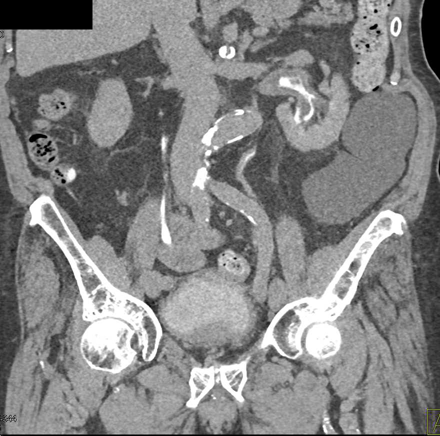 Transitional Cell Carcinoma Left Renal Pelvis and Left Ureter in 3D - CTisus CT Scan