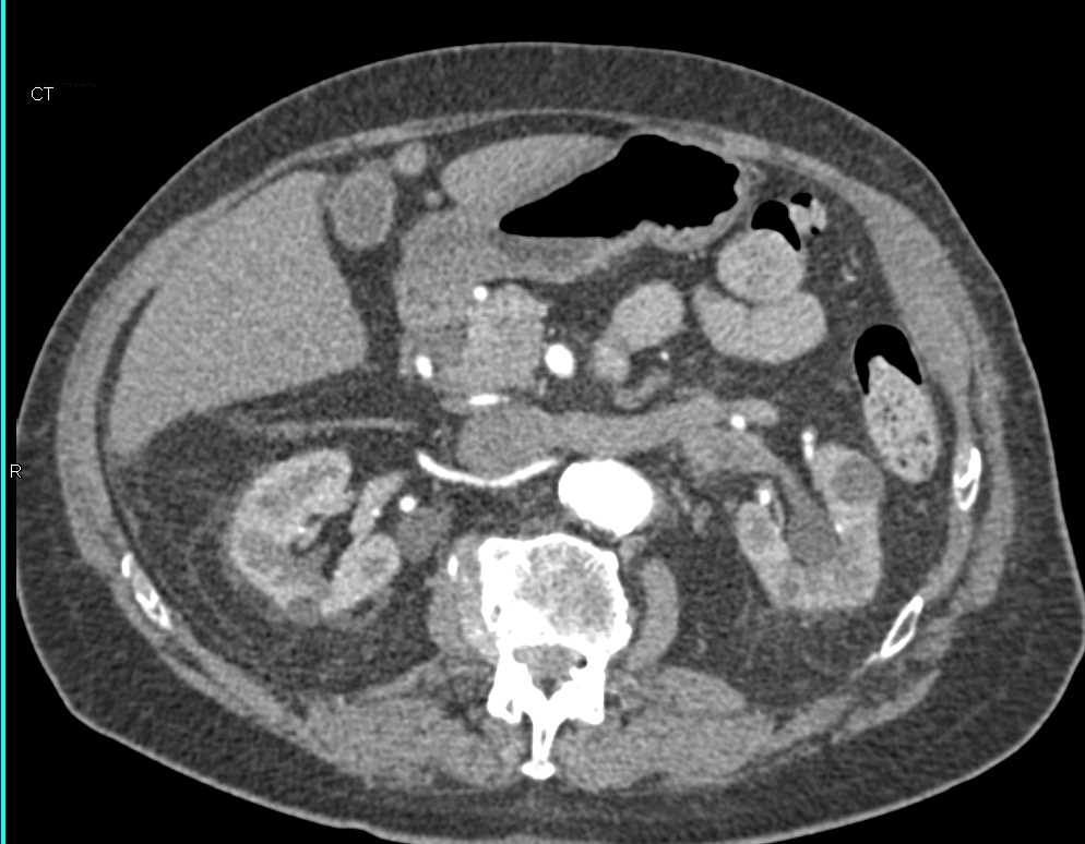 Transitional Cell Carcinoma Left Renal Pelvis and Left Ureter - CTisus CT Scan