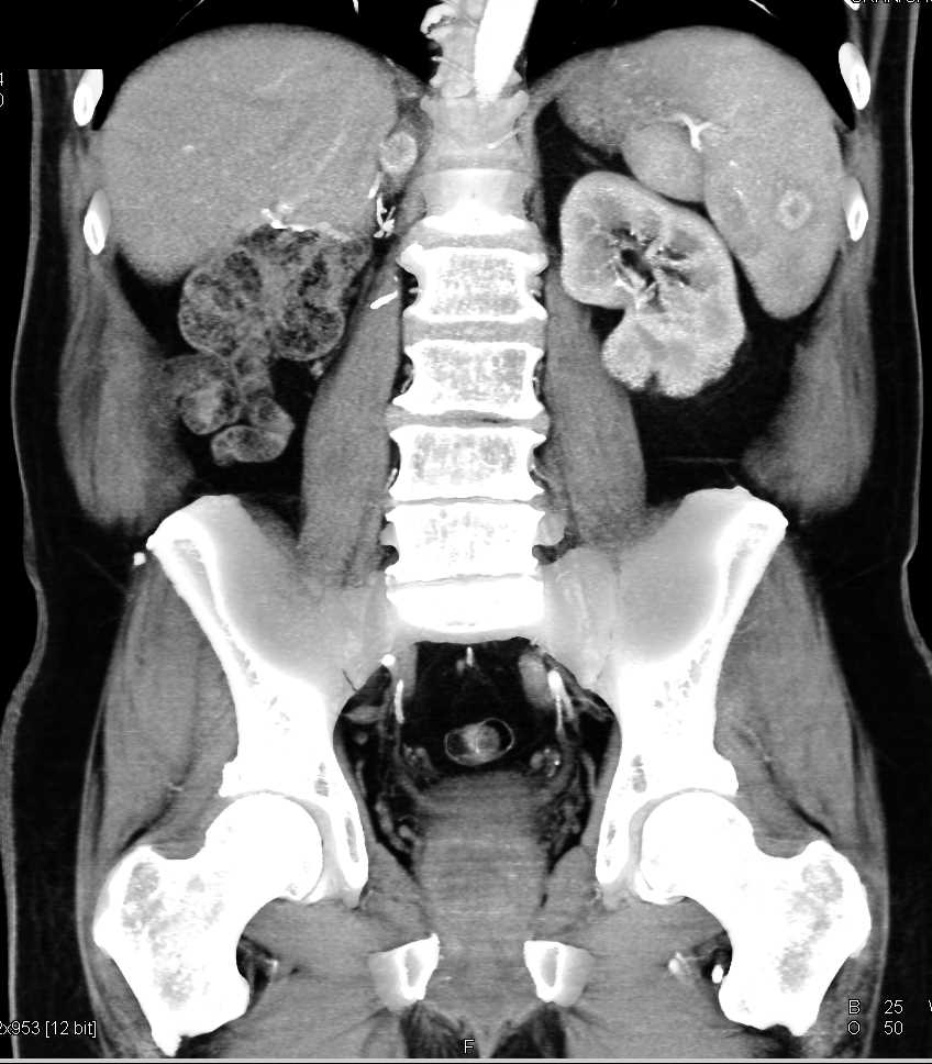 Pseudo lesion Right Renal Fossa - CTisus CT Scan